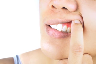 Inflammation i tand och tandkött